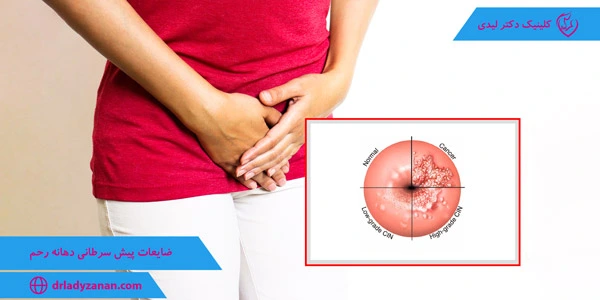Precancerous-lesions-of-the-cervix