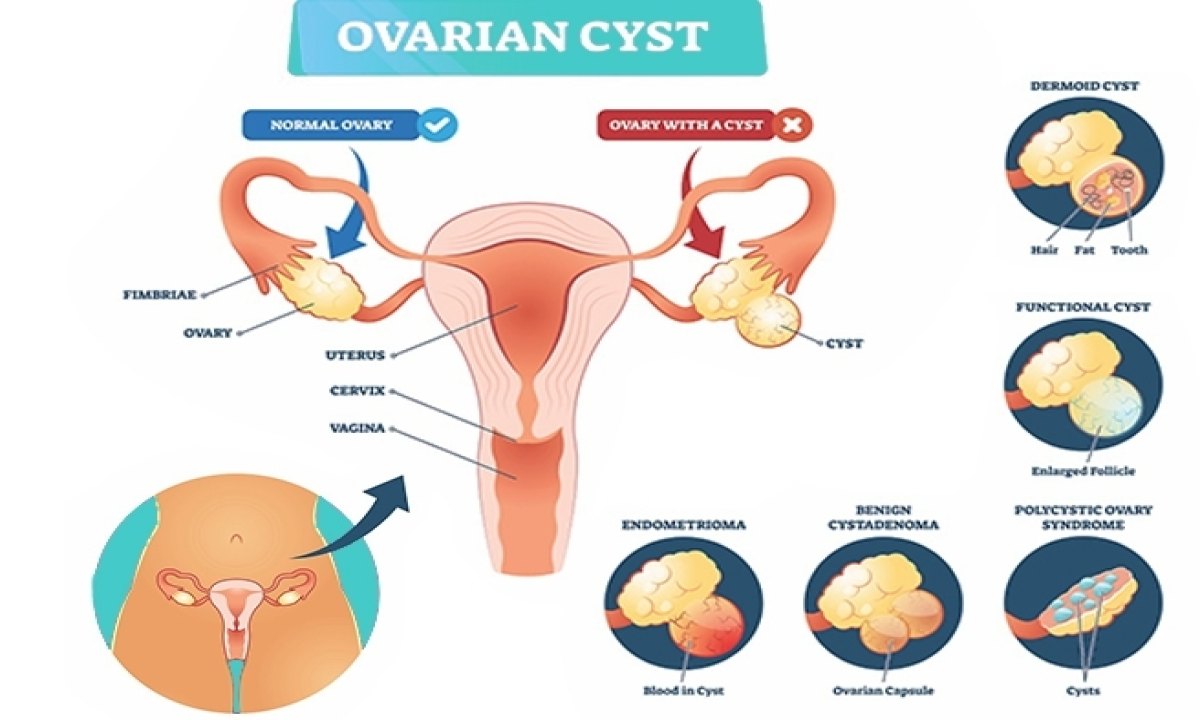 بهترین ورزش برای کیست تخمدان