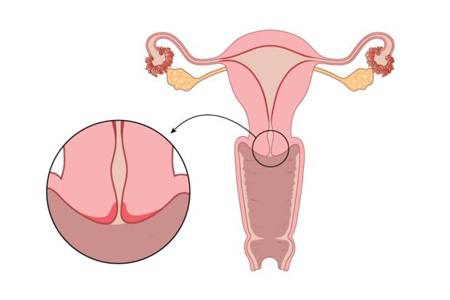خونریزی بعد از فریز زخم دهانه رحم؛ یکی از عوارض جدی و پیچیده فریز زخم دهانه رحم