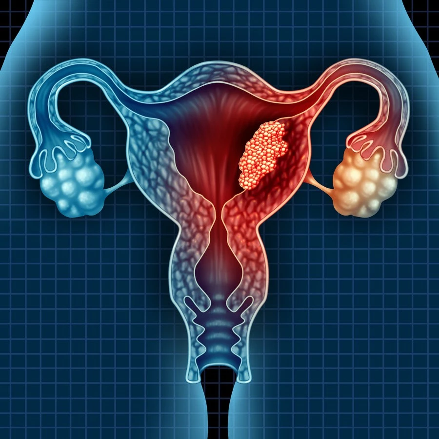 Symptoms-uterine-ovarian-cancer