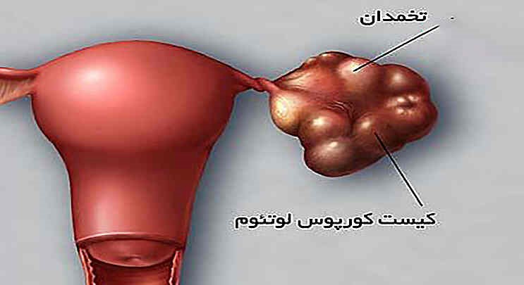 کورپوس لوتئوم چیست