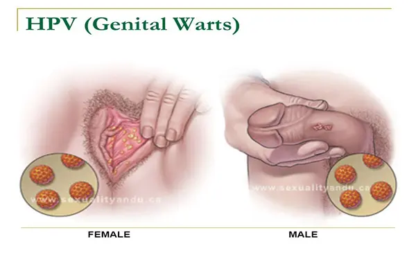 What-doctor-should-be-consulted-genital-warts