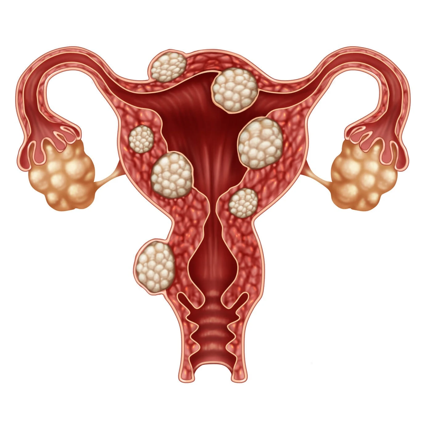 What-is-uterine-cyst
